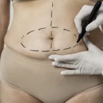how much is a tummy tuck