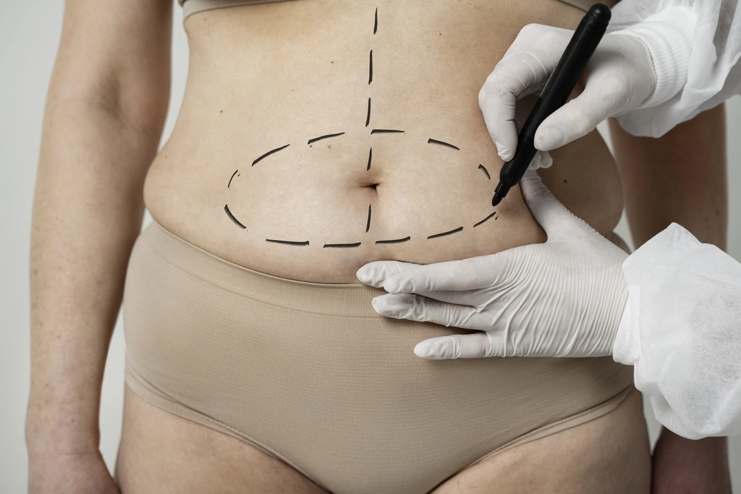 how much is a tummy tuck how much is a tummy tuck